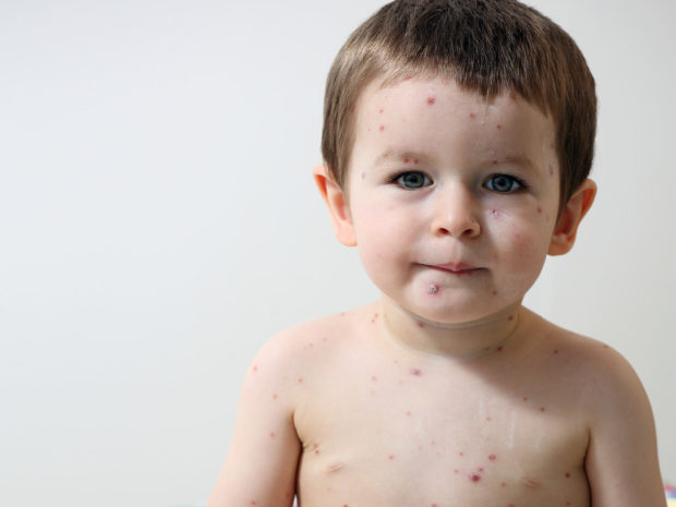 Bambino con croste nel tronco e nel volto dovute alla varicella