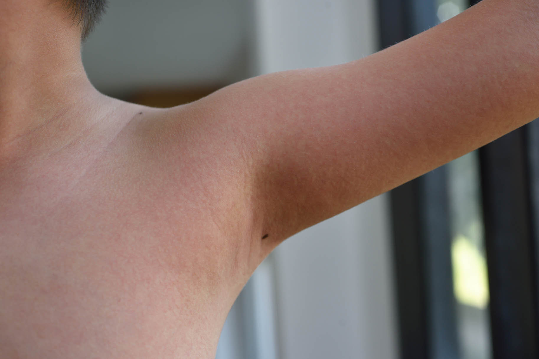 spalla del bambino con macchie rosse per la scarlattina