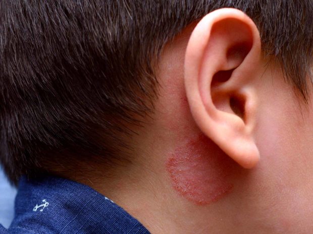 collo di un bambino affetto da tigna del corpo, con tipica macchia rossa circolare sulla pelle