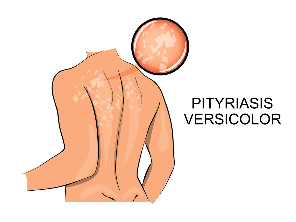 disegno dugli effetti della pitiriasi versicolor