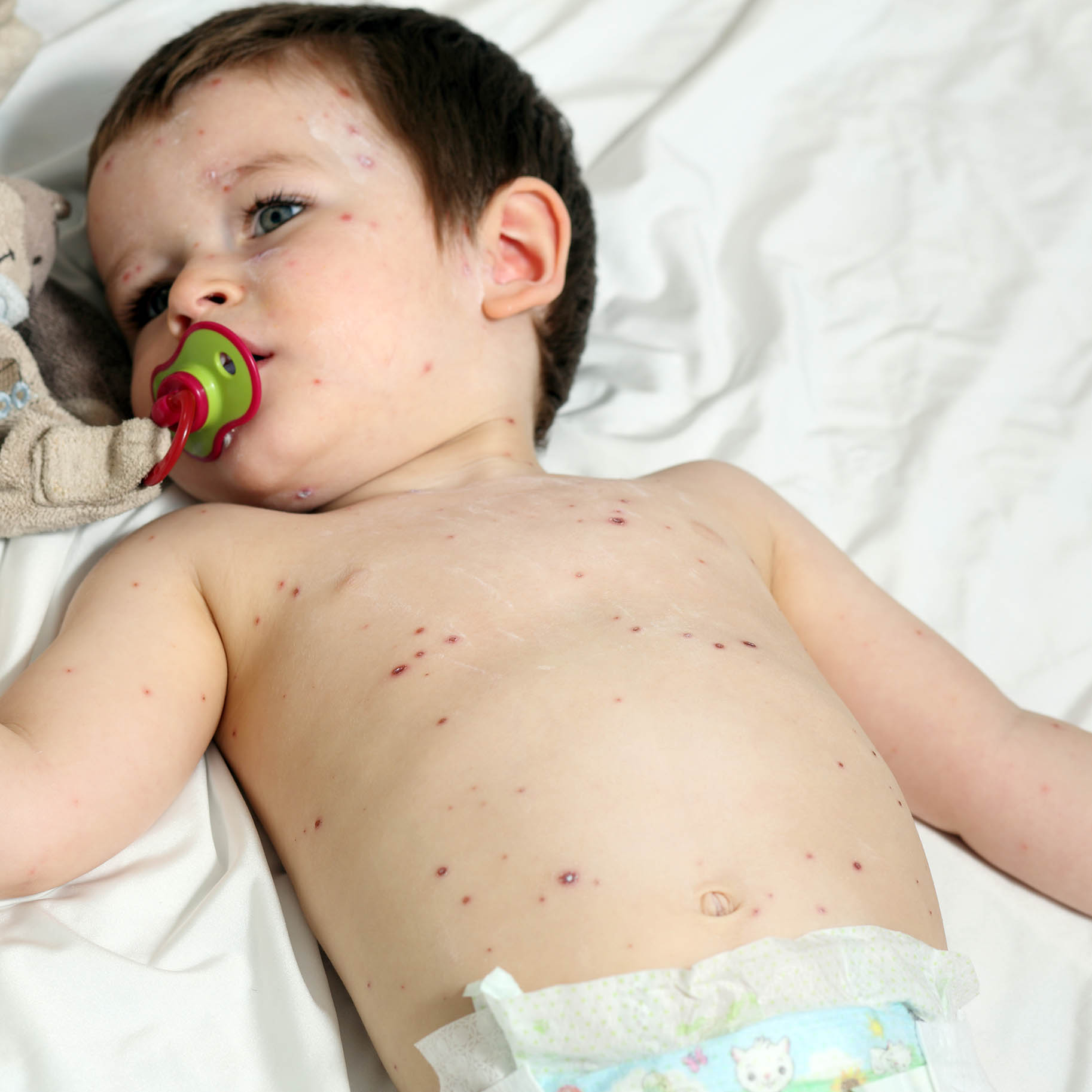 Foto di bambino con pomfi (bolle) da varicella