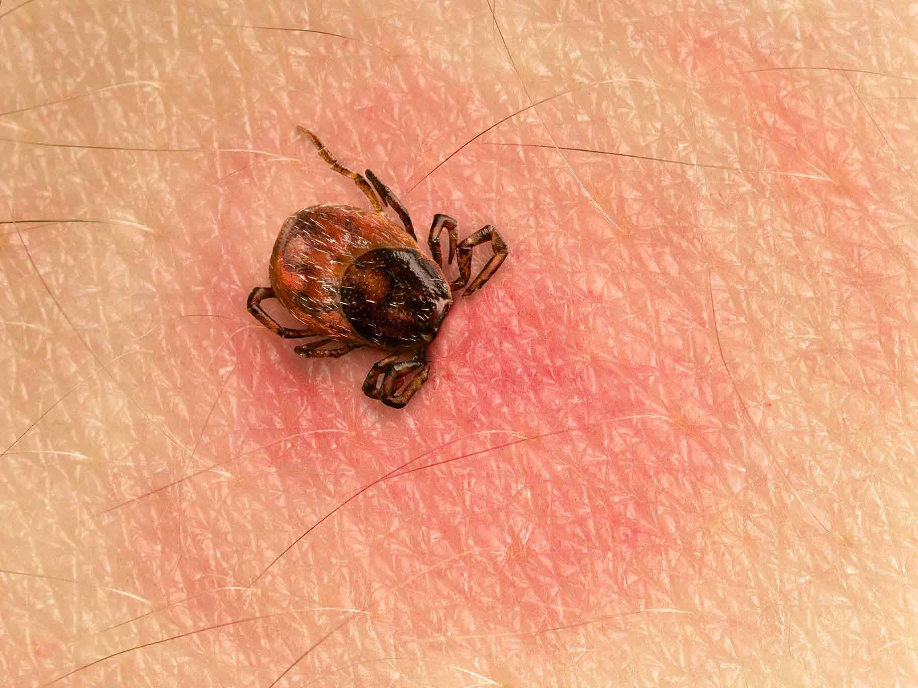 puntura di zecca