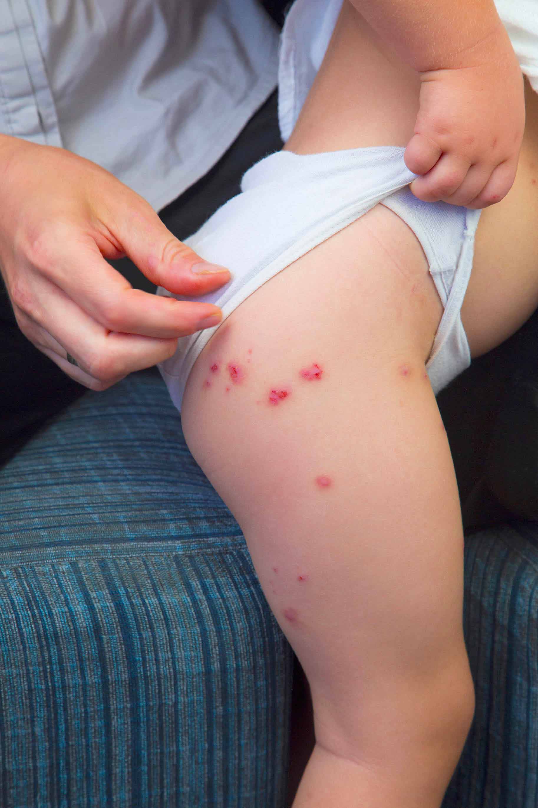 coscia del neonato affetta da impetigine