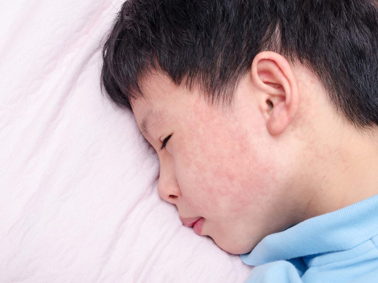 bambino con puntini rossi nelle guance coricato nel letto