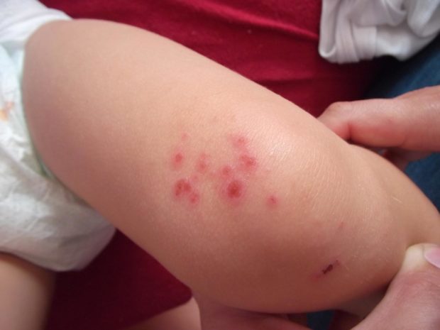 coscia di bambino affetta da impetigine