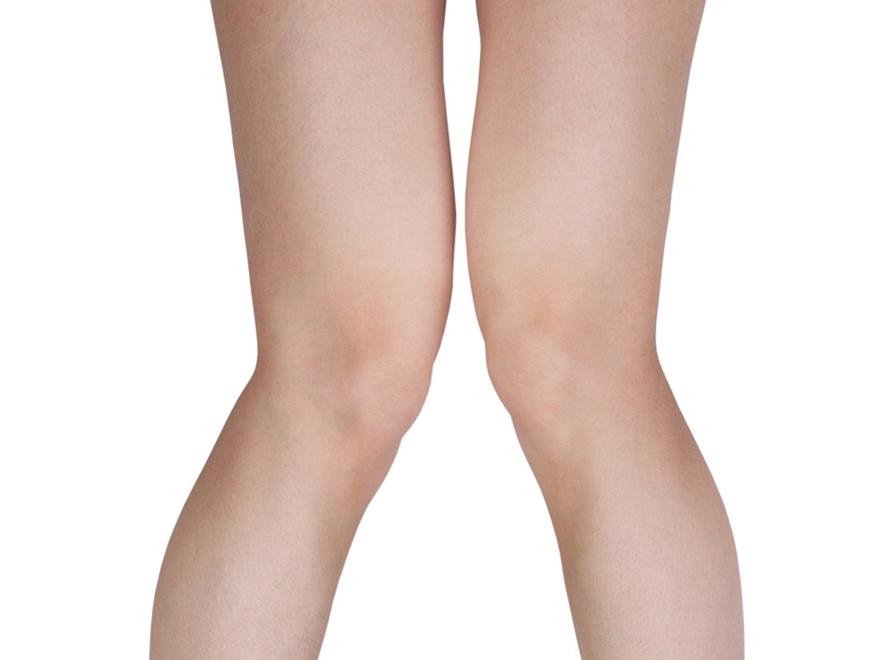 gambe di bambino con ginocchio ad x