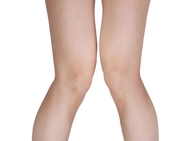 gambe di bambino con ginocchio ad x