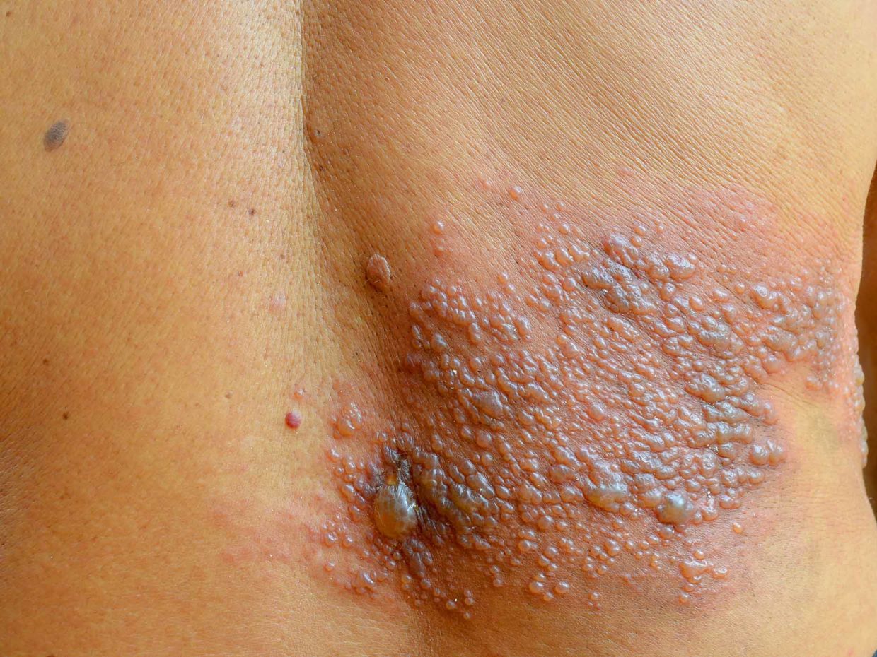 schiena di bambino affetto da herpes zoster (fuoco di sant'antonio)