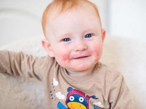 volto di bambino con irritazione alla pelle dovuta a dermatite atopica
