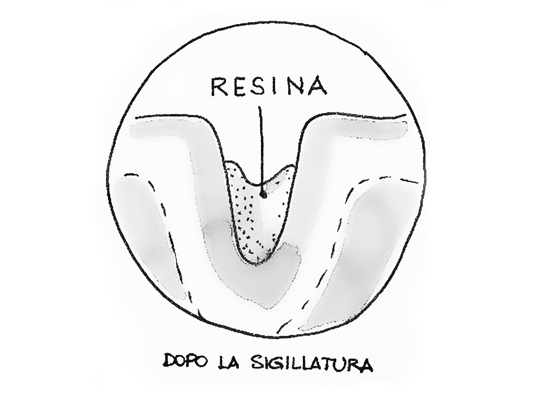disegno che mostra il dente dopo la sigillatura
