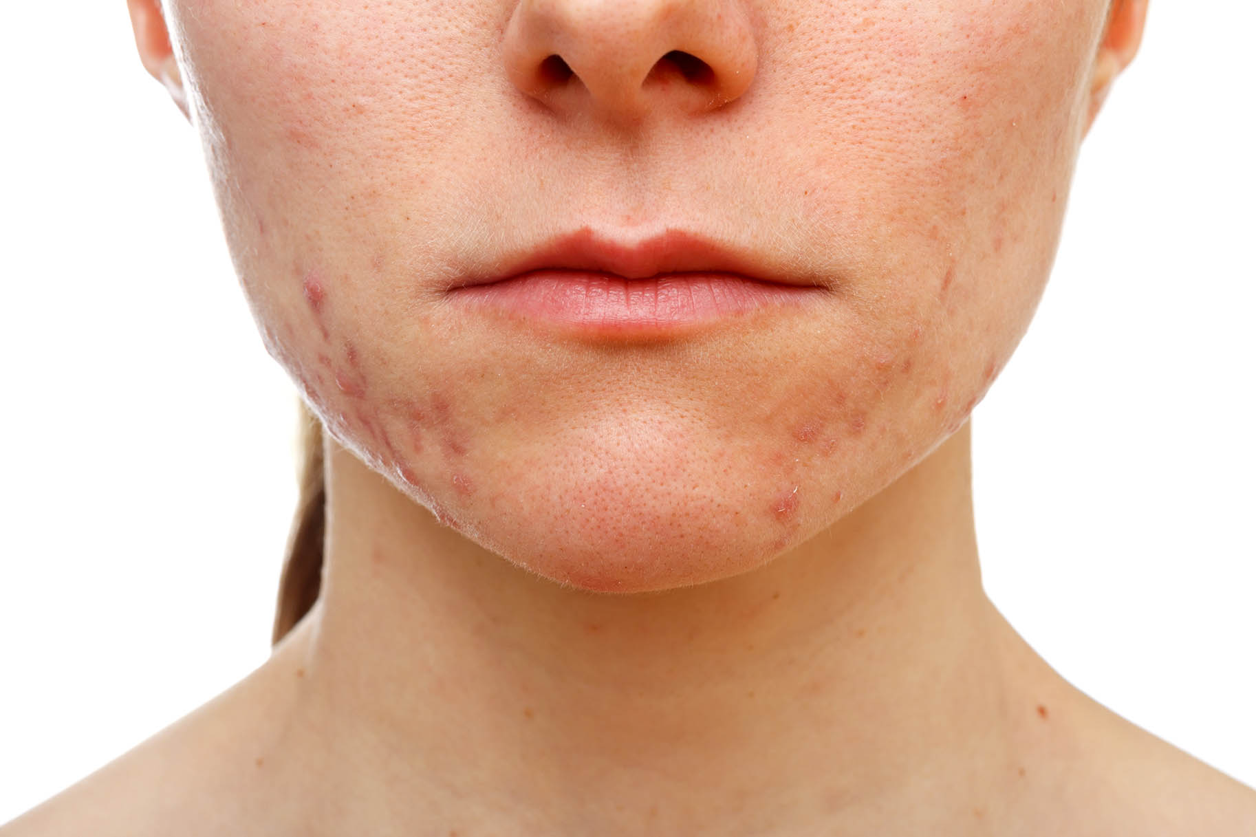 volto di ragazza affetta da acne giovanile