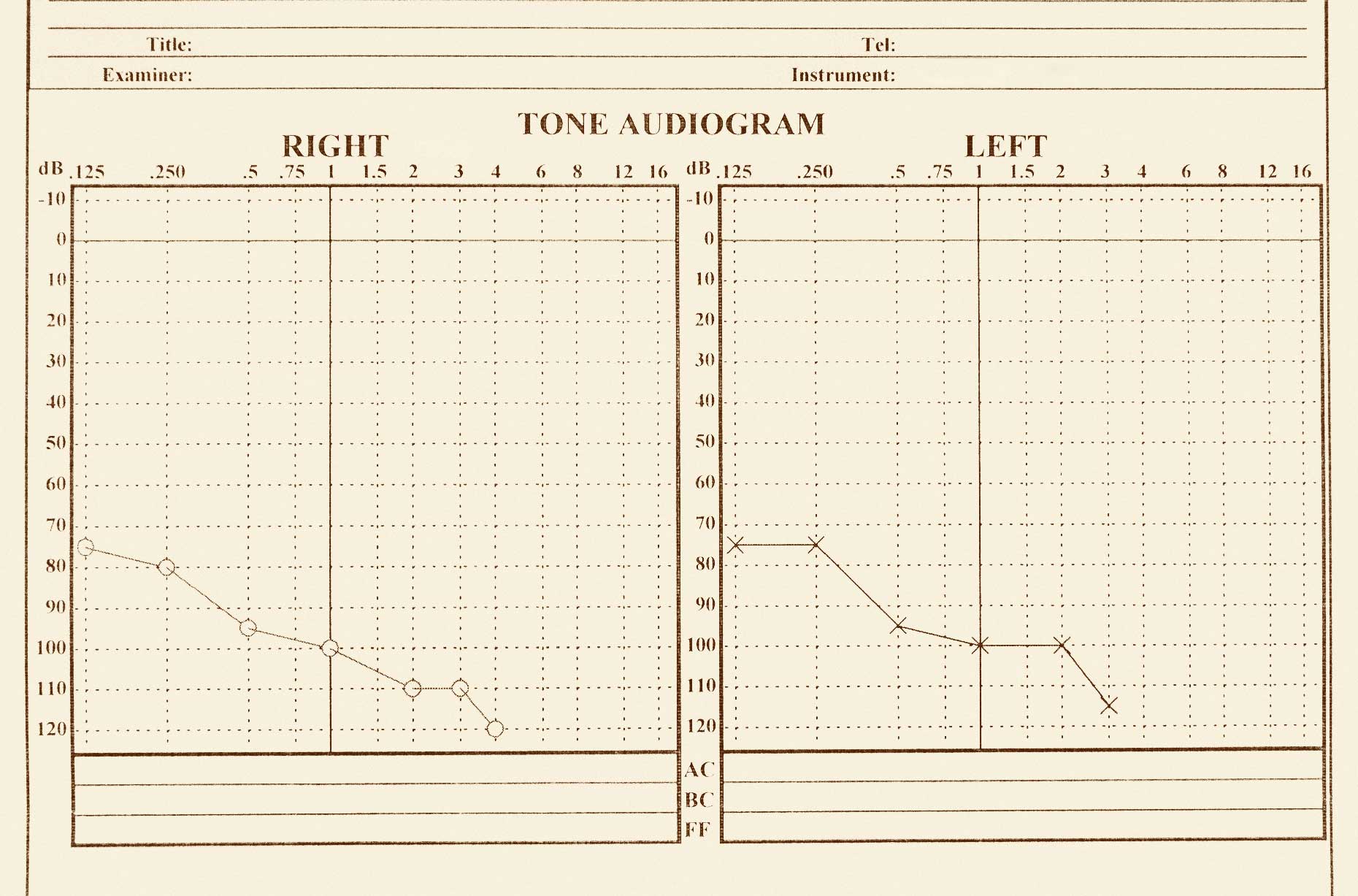 audiometria