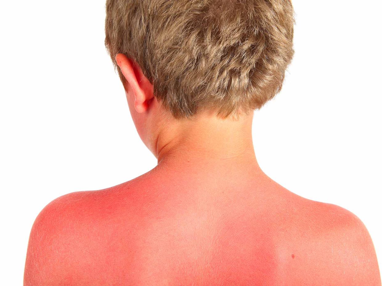 bambino con eritema solare sulla schiena