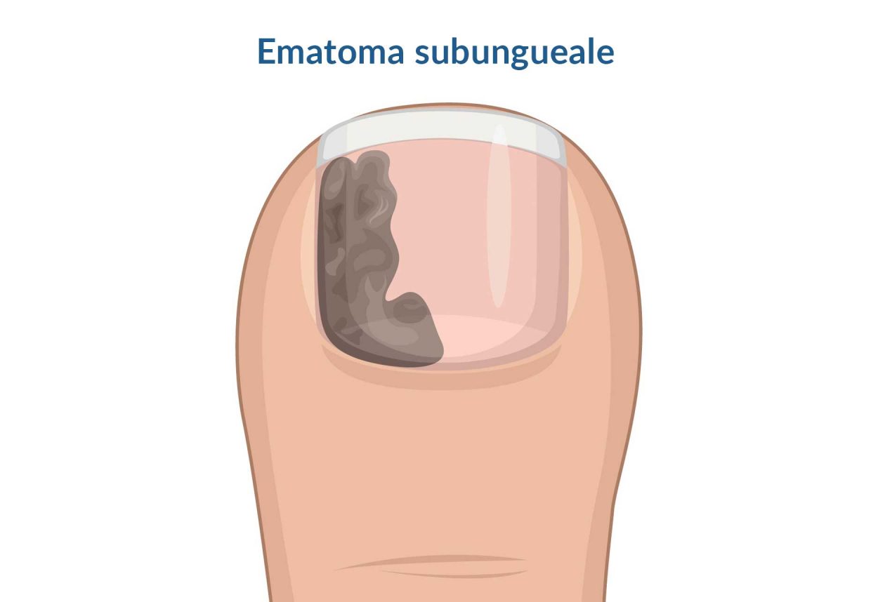 immagine unghia con ematoma subungueale