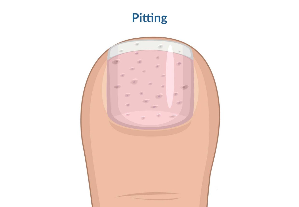 immagine dell'unghia colpita da pitting