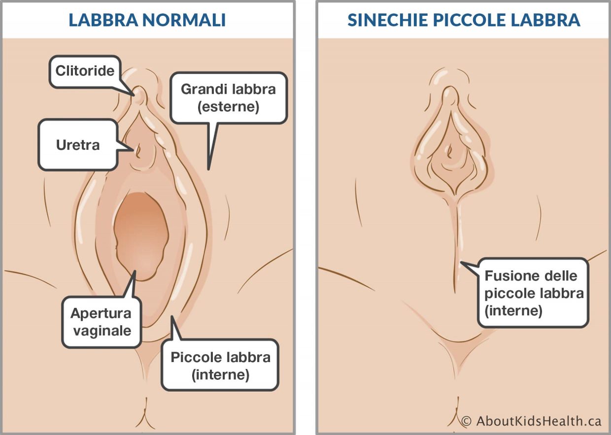 Sinechie delle piccole labbra nelle bambine: cosa fare - Amico Pediatra
