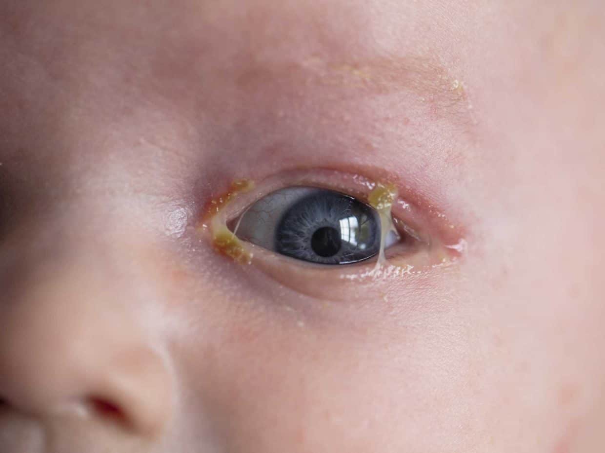 Bambino con congiuntivite infettiva