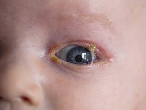 Bambino con congiuntivite infettiva