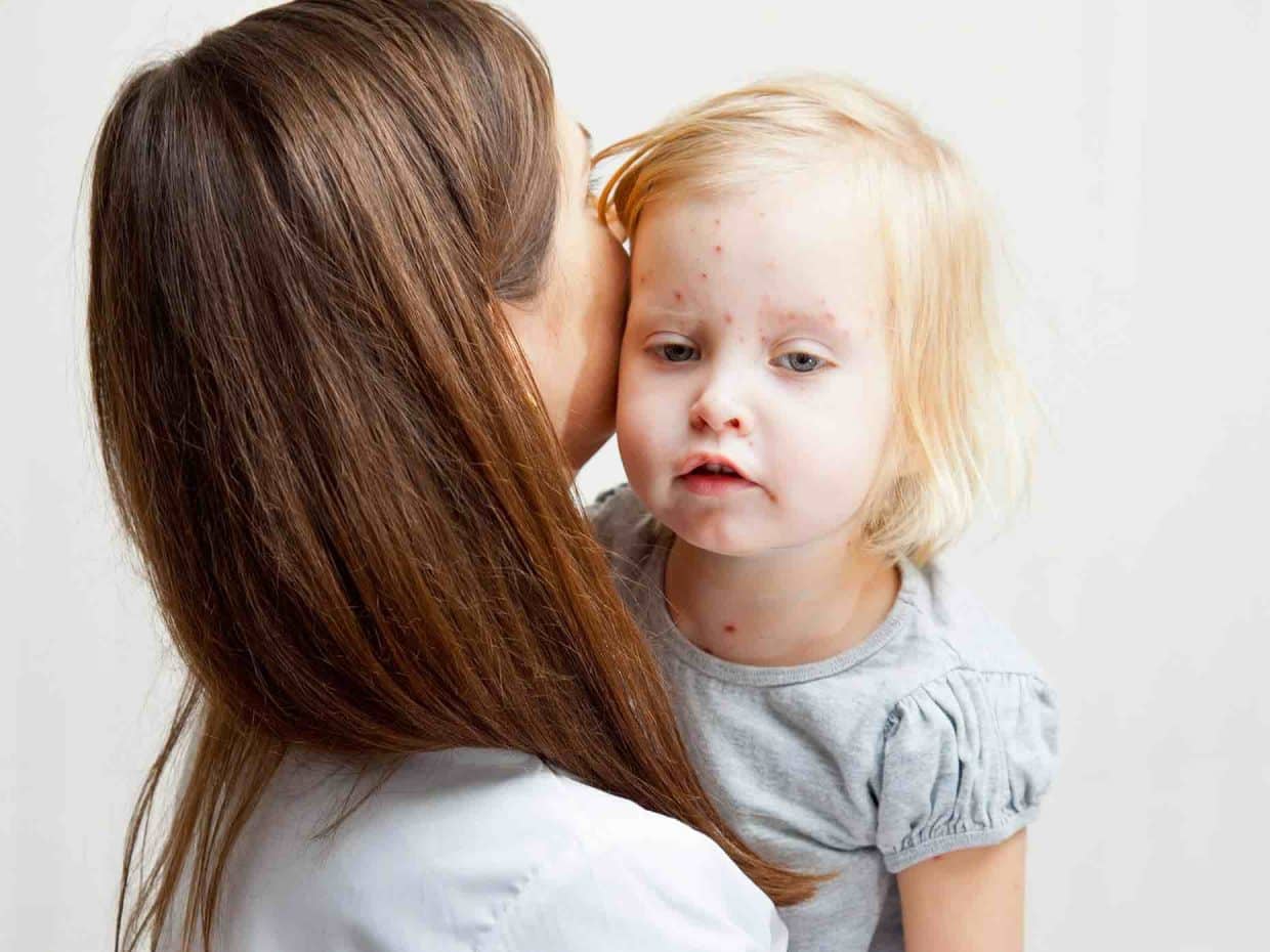 Esantema della varicella in fase avanzata: le vescicole si trasformano in croste.