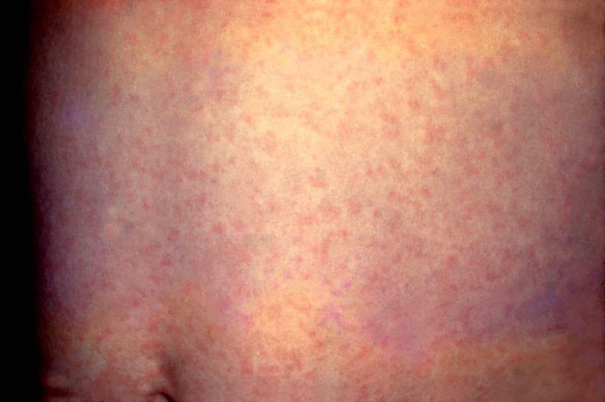 Esantema della rosolia: macchie color rosa prima al viso e poi al tronco e agli arti