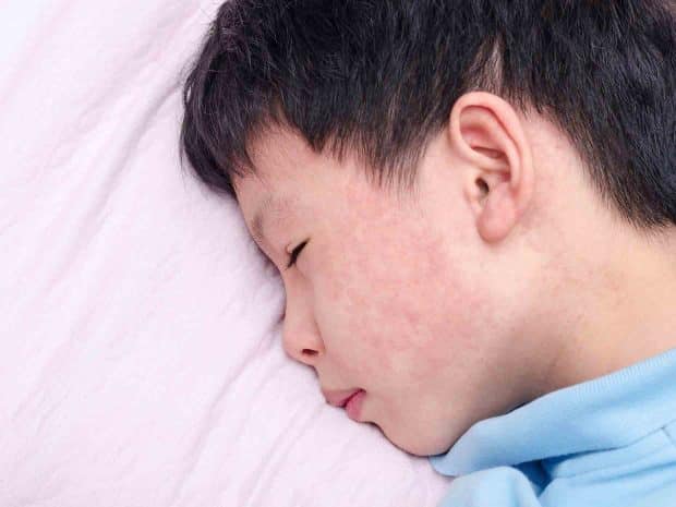 Bambino con quinta malattia e tipica lesione a guancia schiaffeggiata