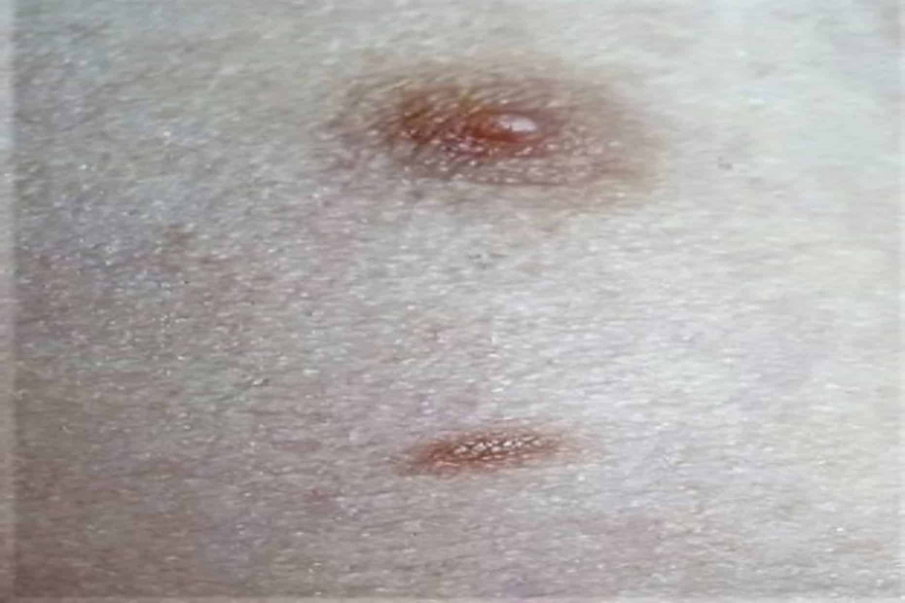 Immagine clinica di un terzo capezzolo in un bambino.