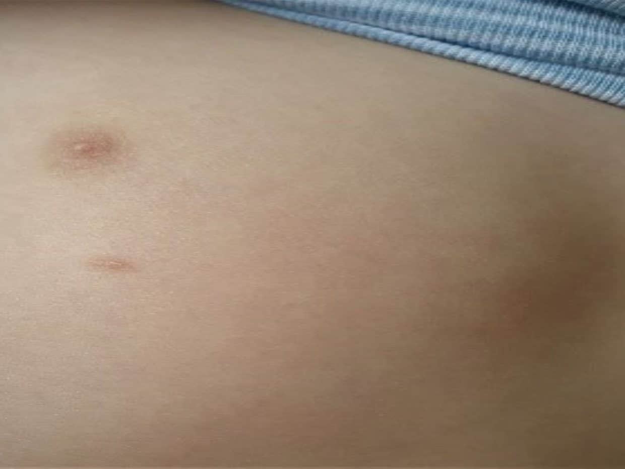 Fotografia clinica di un terzo capezzolo in un bambino.