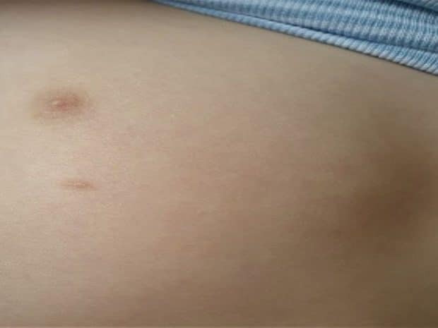 Fotografia clinica di un terzo capezzolo in un bambino.