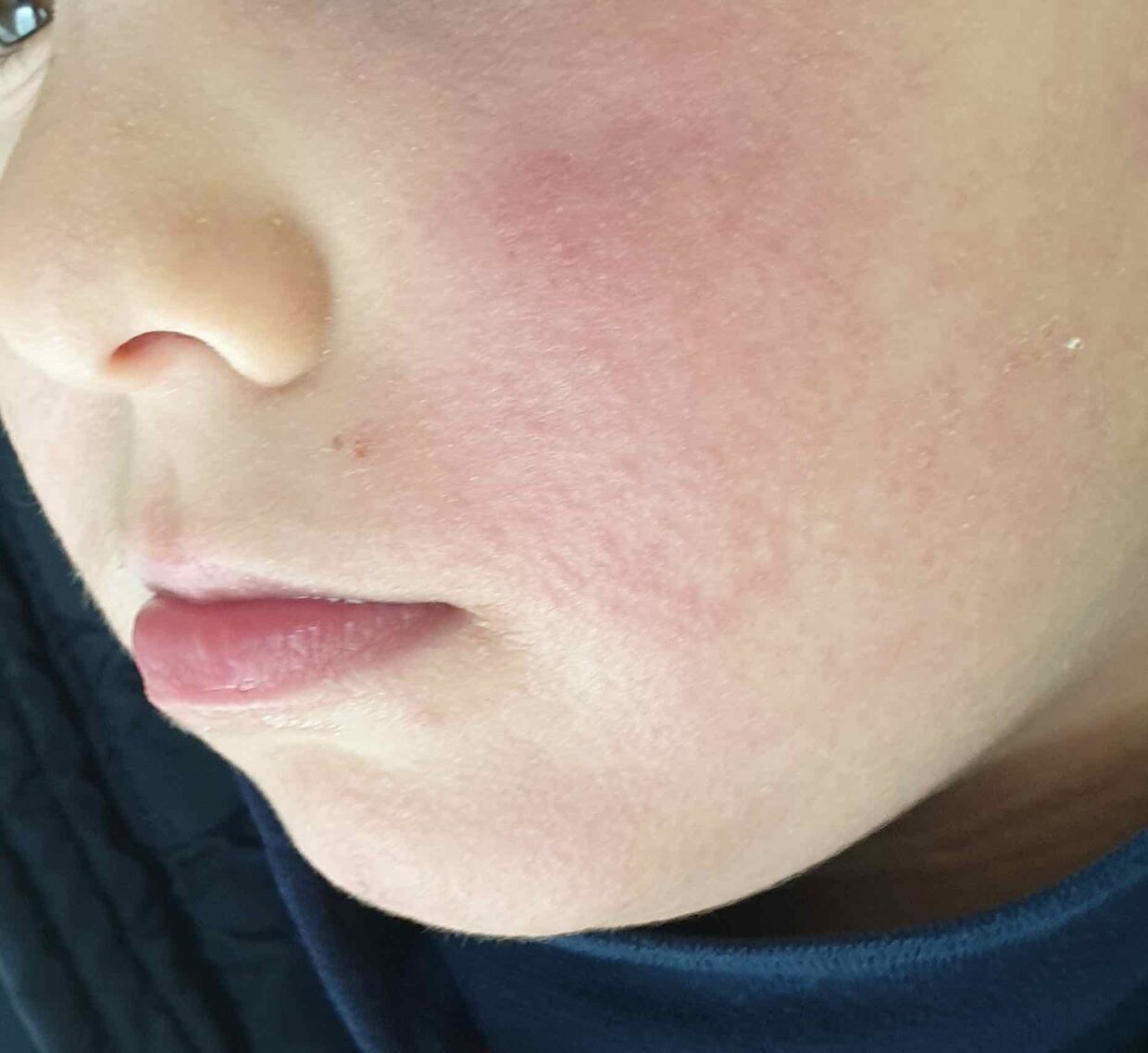 Puntini rossi della scarlattina sul viso