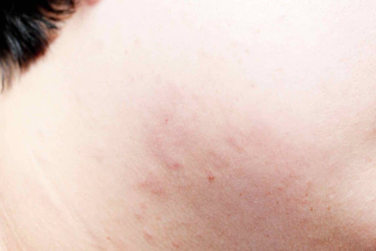 Eruzione cutanea da acaro