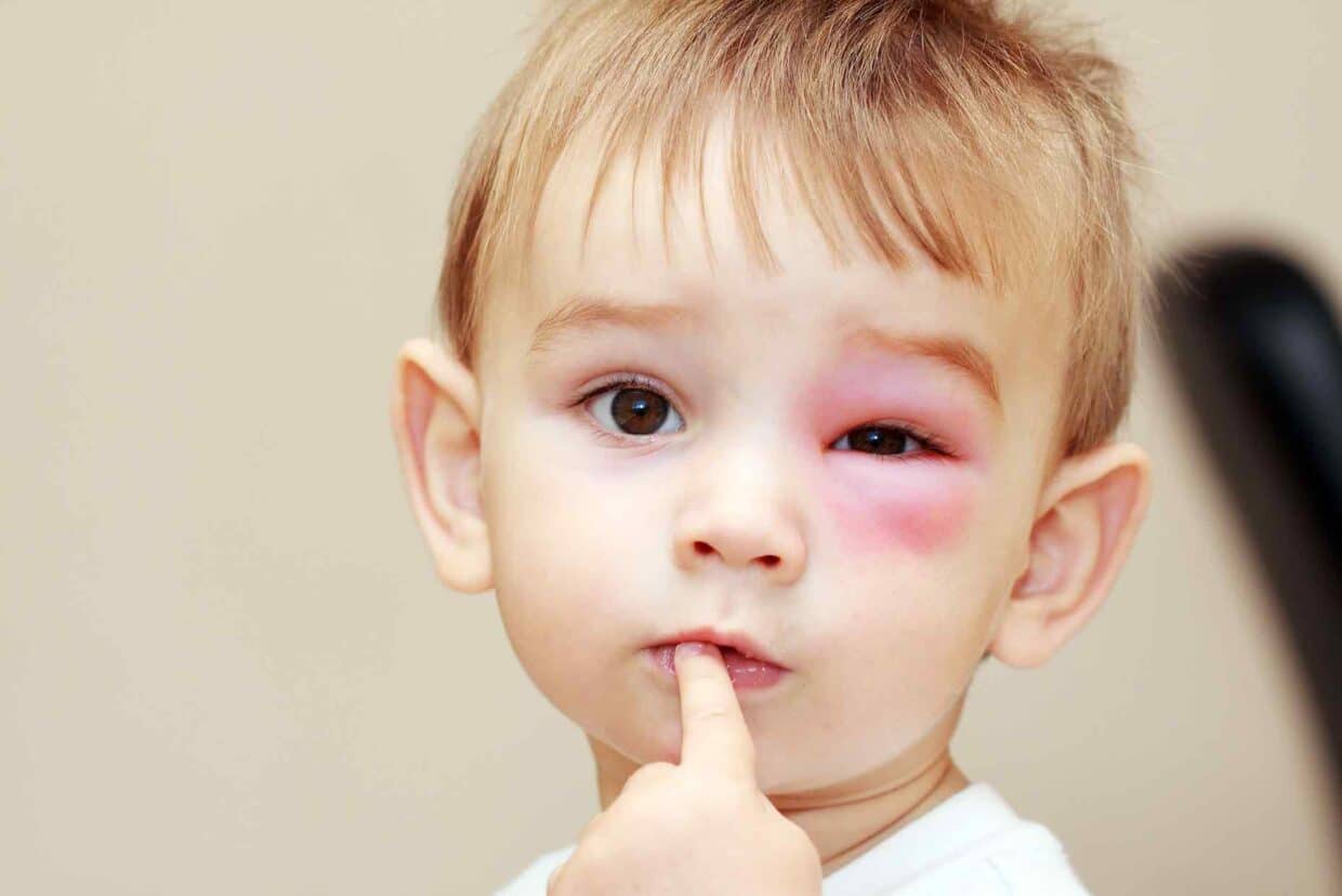 Puntura di calabrone su occhio di bambino