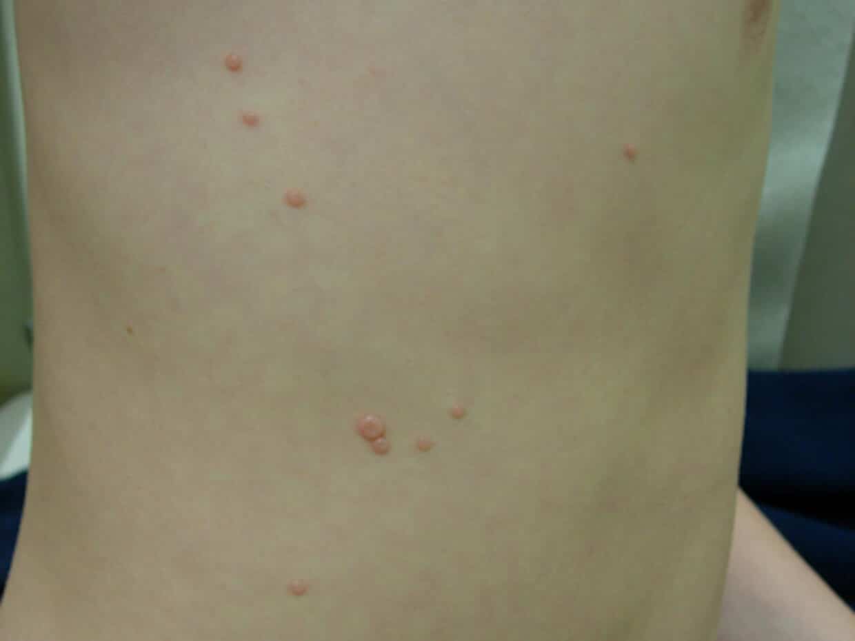 Bambino con molluscio contagioso