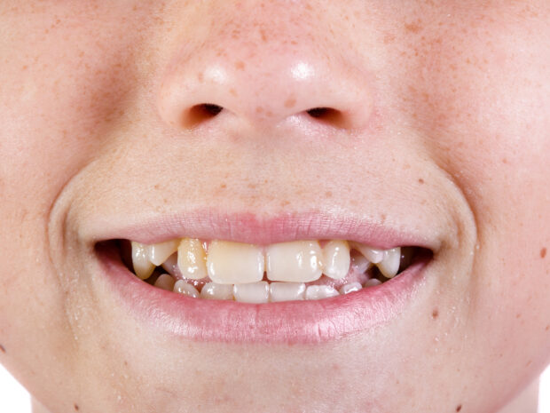 Celiachia e denti