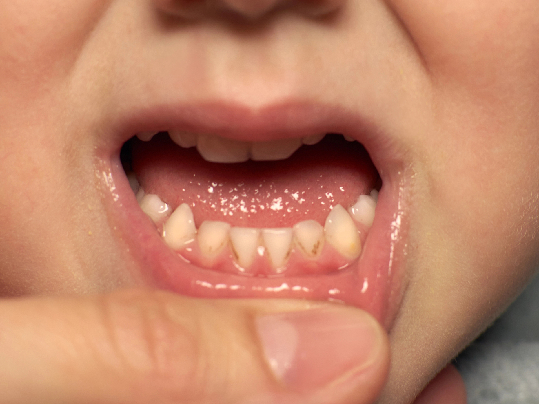 Celiachia e macchie sui denti: black stain