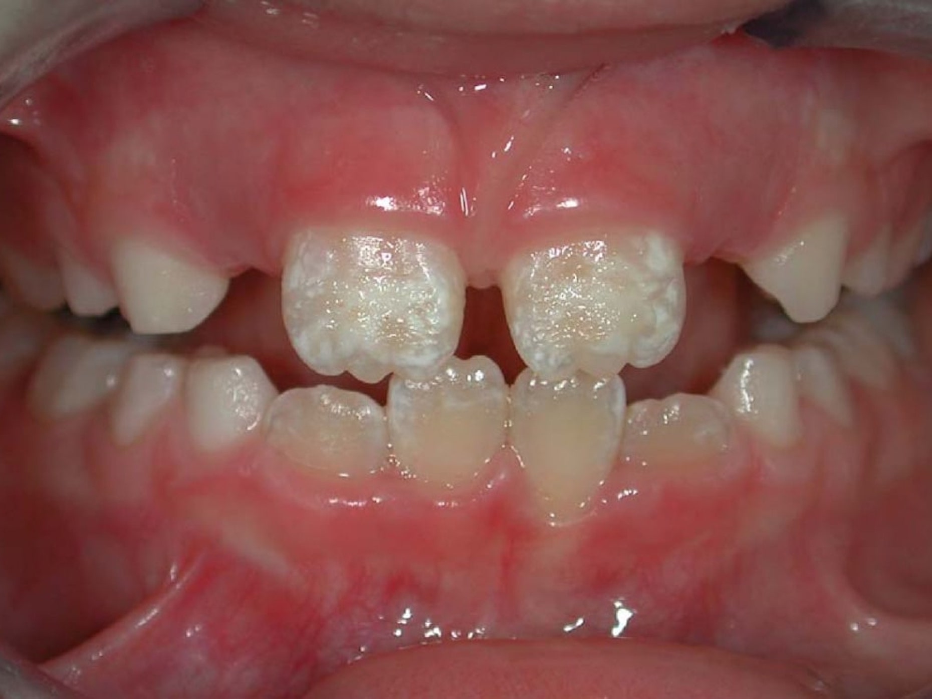 Celiachia e denti: difetti dello smalto in bambino celiaco