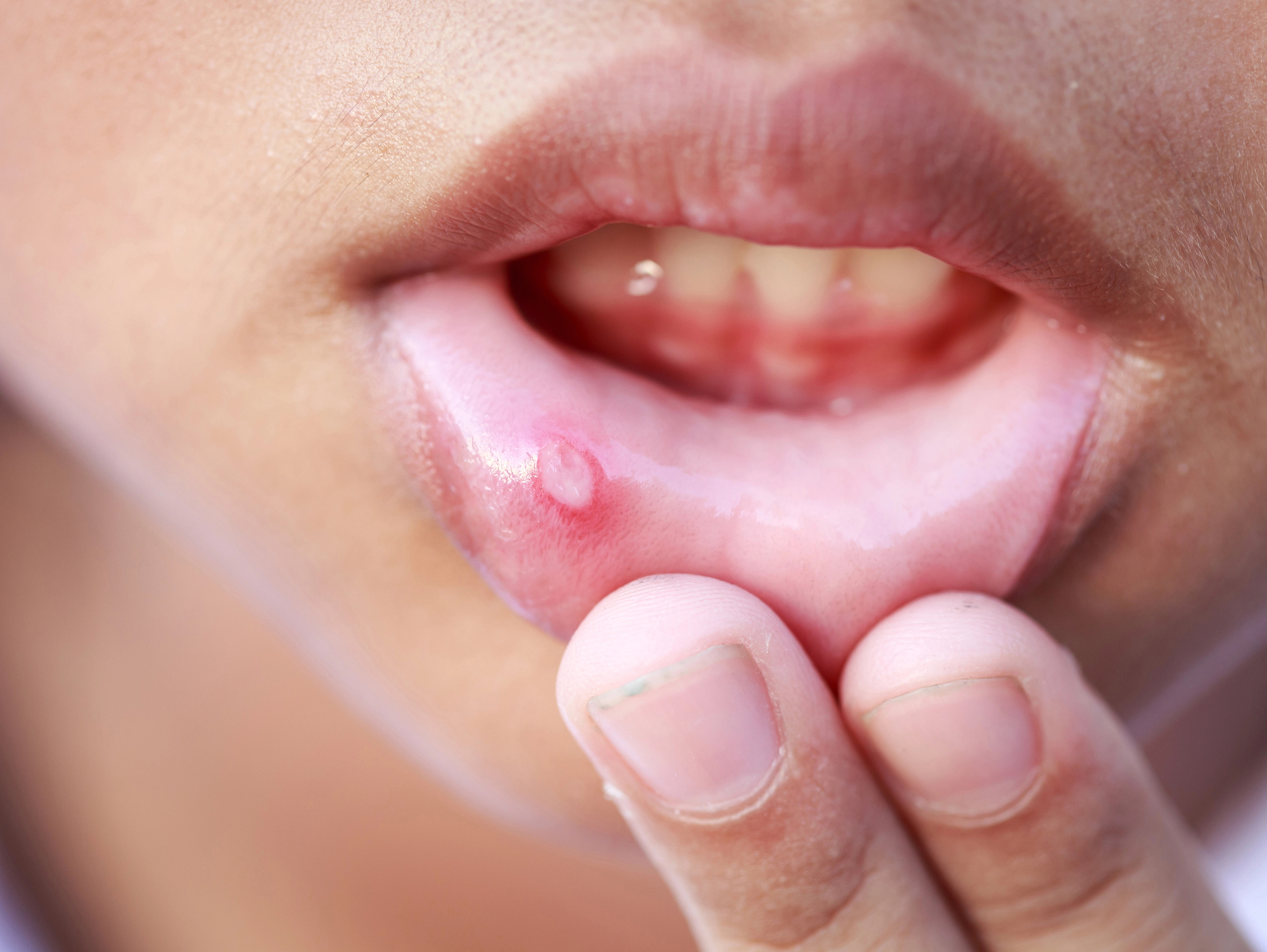 Celiachia e denti: afte ricorrenti