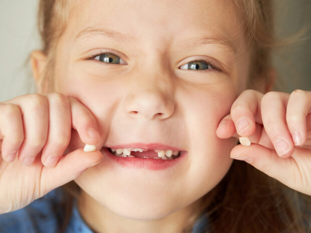 Bambina che mostra denti da latte caduti senza radice