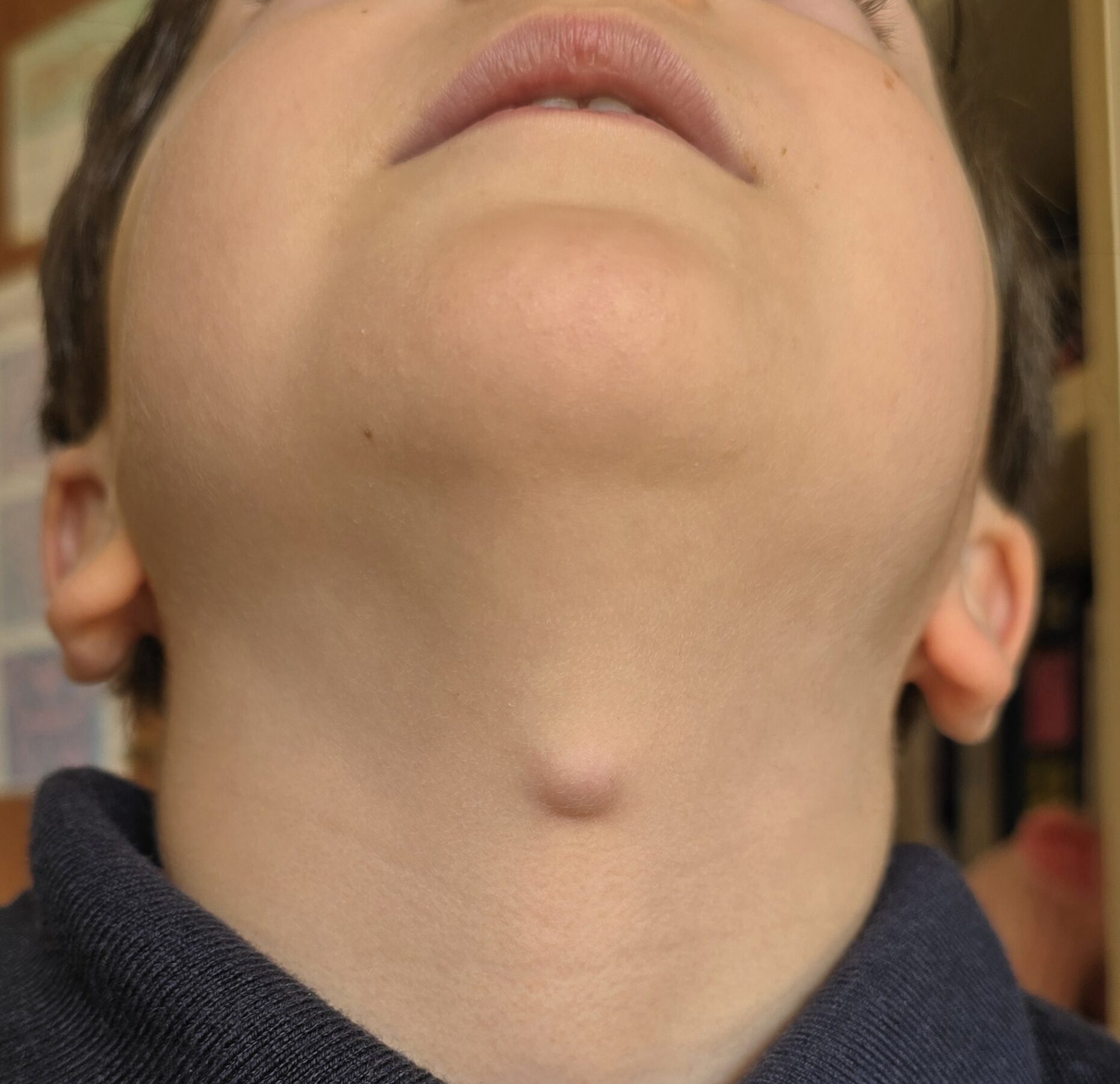 Immagine clinica di una cisti mediana del collo