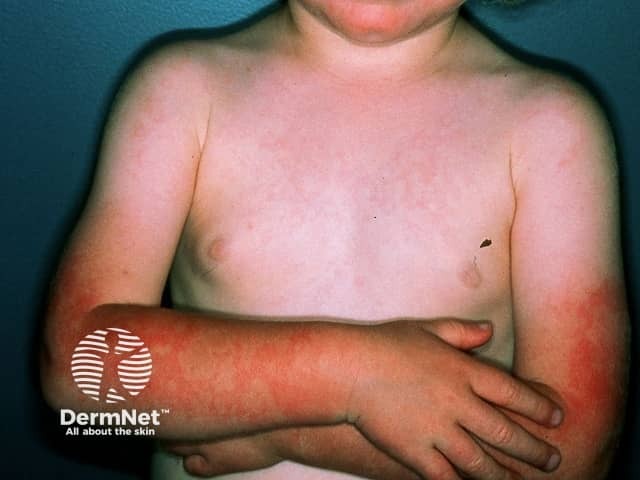 Bambino con esantema da quinta malattia molto evidente su braccia e tronco