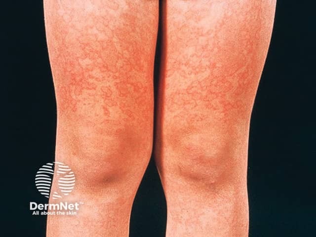 Bambino con esantema da quinta malattia sulle gambe