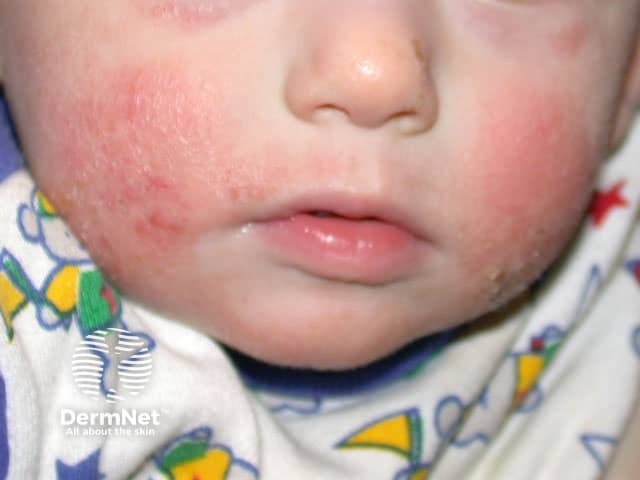 Bambino con dermatite atopica sulle guance