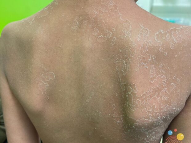 Esantema da scarlattina: si notino i "puntini" rossi, fittissimi, poco rilevati, che in alcune zone confluiscono in chiazze più grandi. Per gentile concessione di Dftbskindeep.com