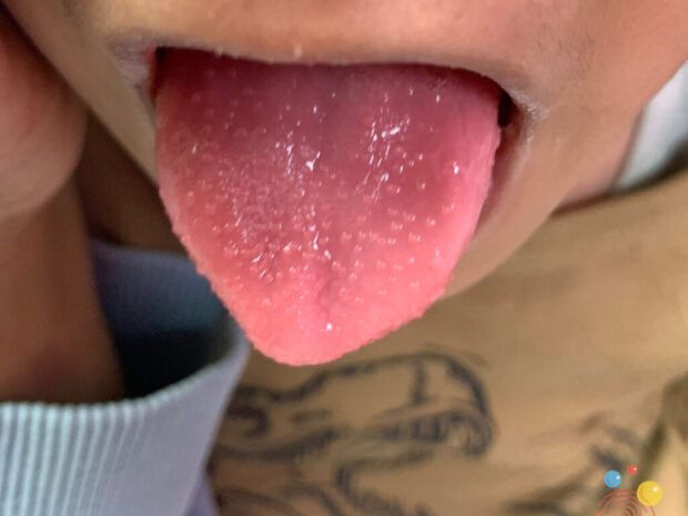 Lingua a fragola in bambino affetto da scarlattina: mucosa arrossata e papille ingrossate