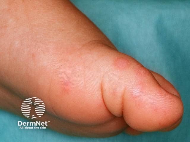 Vescicole sul piede causate dalla malattia mani piedi bocca sul piede