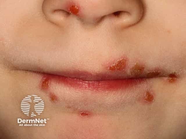 Stomatitis da malattia mani piedi bocca, caratterizzata da vescicole attorno alla bocca e sul naso