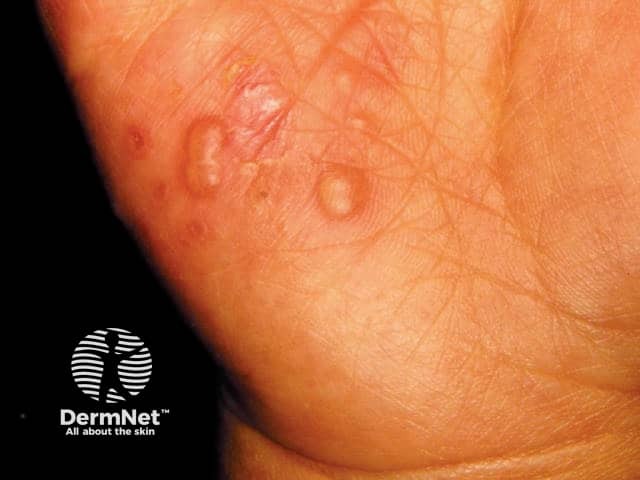 Vescicole ripiene di liquido sul palmo della mano di un bambino affetto da malattia mani piedi bocca