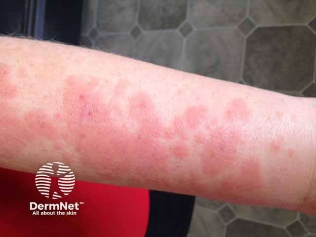 Immagine clinica di dermatite polimorfa solare su un braccio: l'eruzione cutanea con prurito e bruciore è comparsa qualche ora giorno dopo l'esposizione al sole.