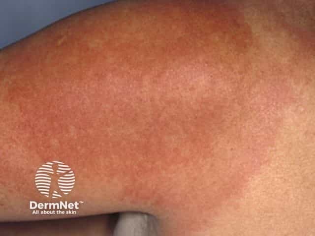Immagine clinica di eritema cronico migrante