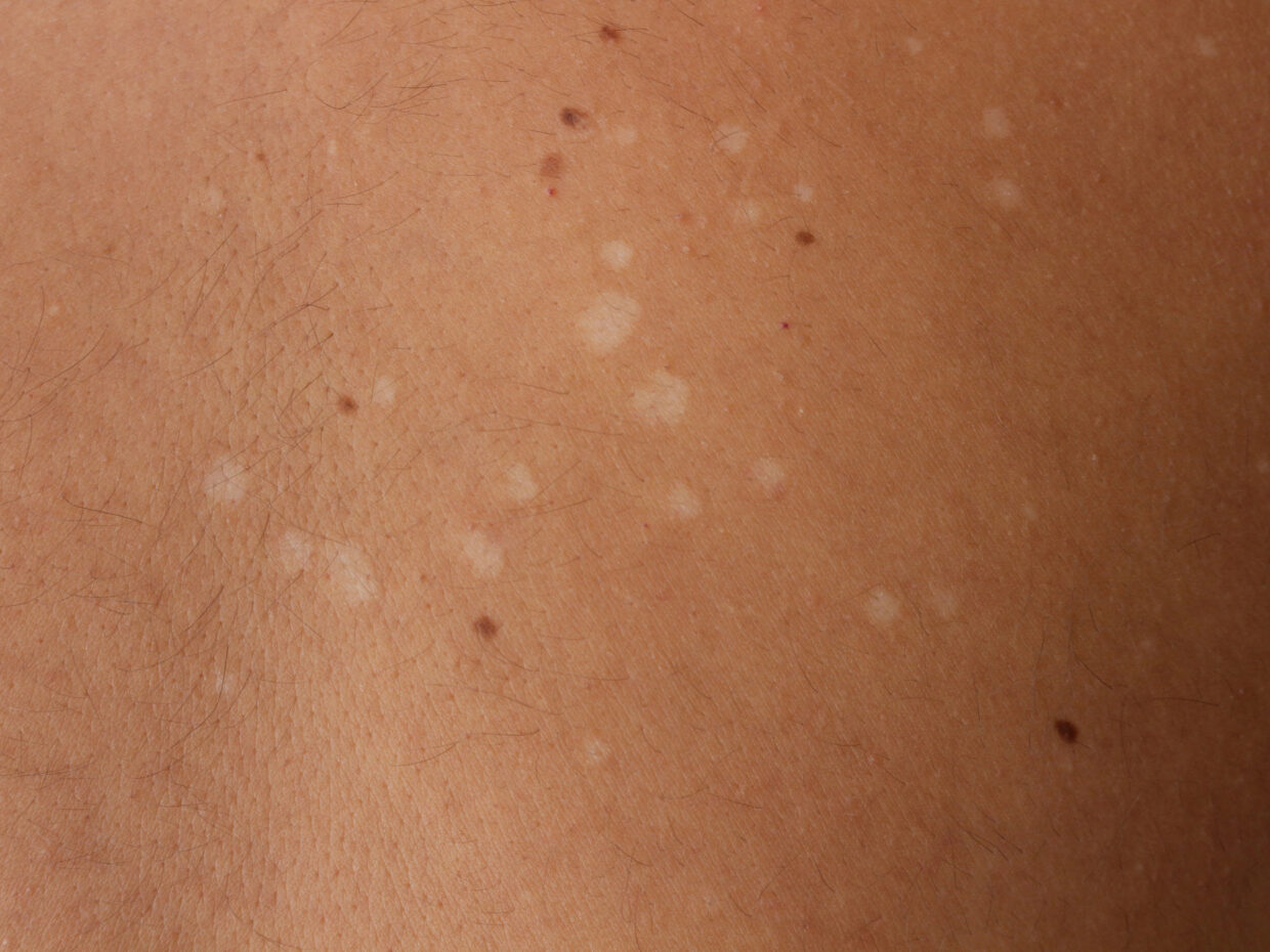 Immagine clinica della pelle di un bambino con pitiriasi versicolor