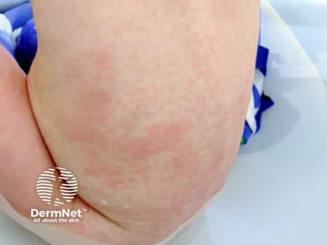 Bambino con esantema da rosolia (schiena)